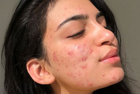 CÁC BƯỚC CHĂM SÓC DA DẦU MỤN HIỆU QUẢ 